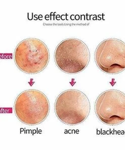 HUINI Personal Care 7-Piece Blackhead Remover Kit - Pimple Comedone Extractor